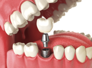 dental implants Complete Dental Care dentist in Spokane WA