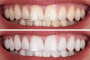 teeth whitening complete dental care Dentist Spokane WA, Kellogg ID