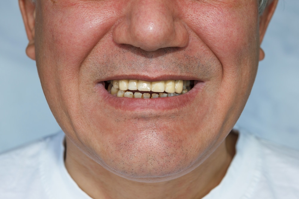 dental bridges complete dental care dentist in Spokane, WA and Kellogg, ID. Man,With,False,Front,Upper,Teeth,(dental,Bridge)