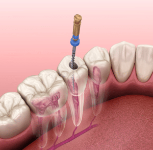 root canal therapy illustration